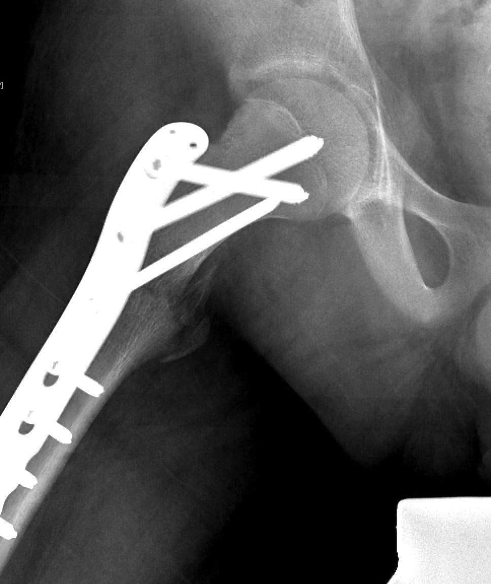 Paediatric Intertrochanteric NOF ORIF